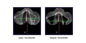 Sinusitis-ozono