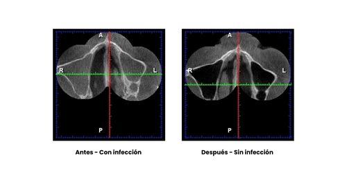 Sinusitis-ozono