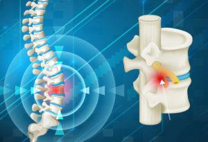 hernia discal en Pamplona